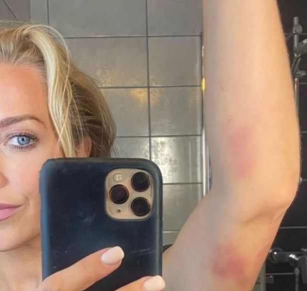 A Place In The Sun's Laura Hamilton reveals painful symptoms of bleeding disorder Laura Hamilton