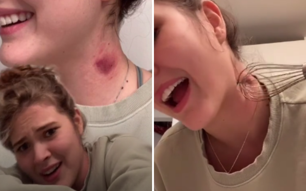 TikTok teens use kitchen whisks to eliminate hickeys. But does it work?