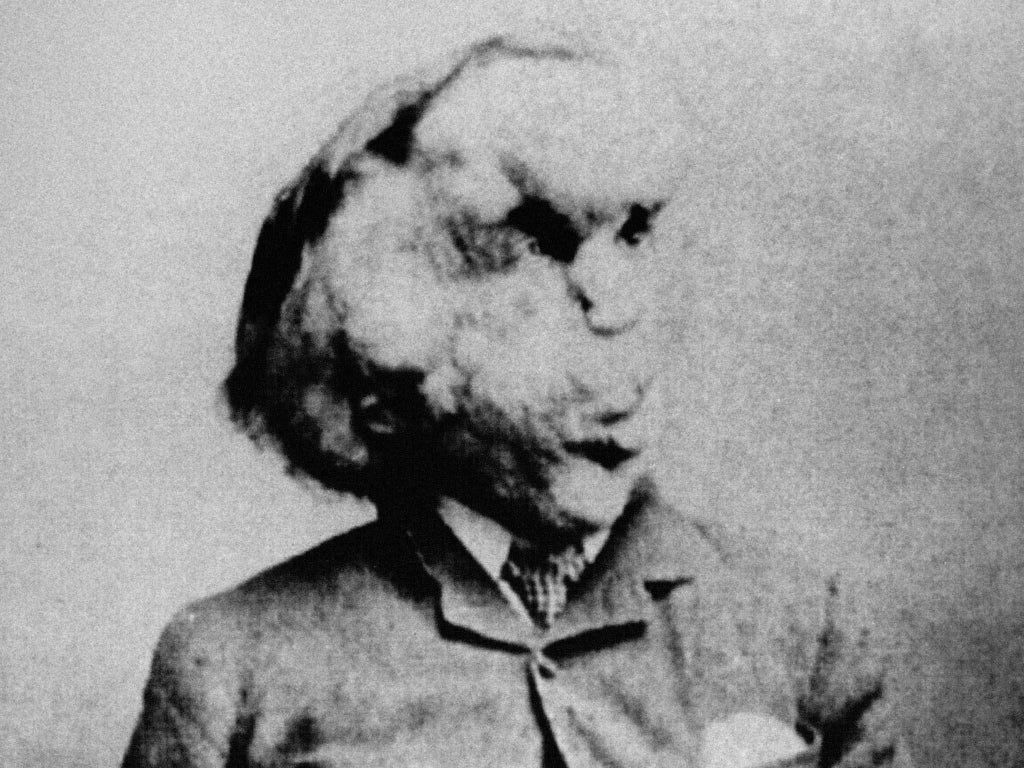 ‘Modern-day freak show’: Thousands sign petition to stop Elephant Man dissection event